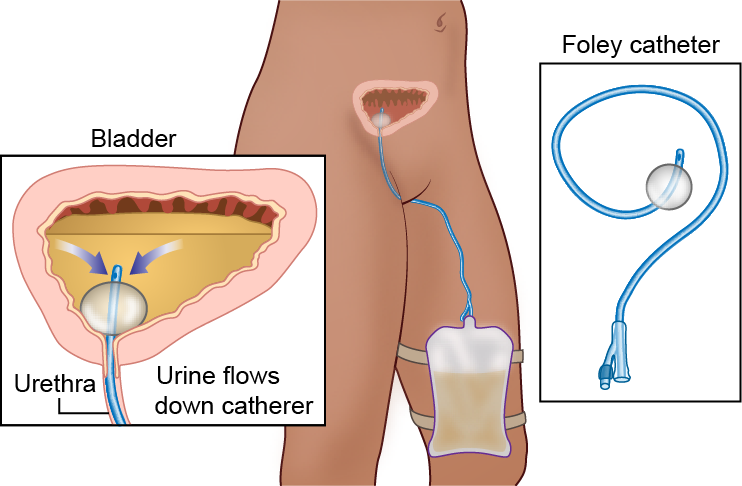 Why a Patient Would Get a Foley Urinary Catheter